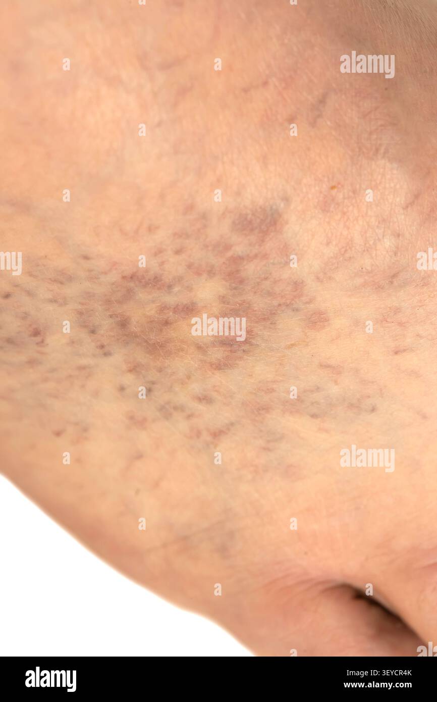 Vene ragni e problemi dei vasi sanguigni in un piede maschio adulto causati da insufficienza venosa cronica, con conseguente scarsa circolazione. Foto Stock