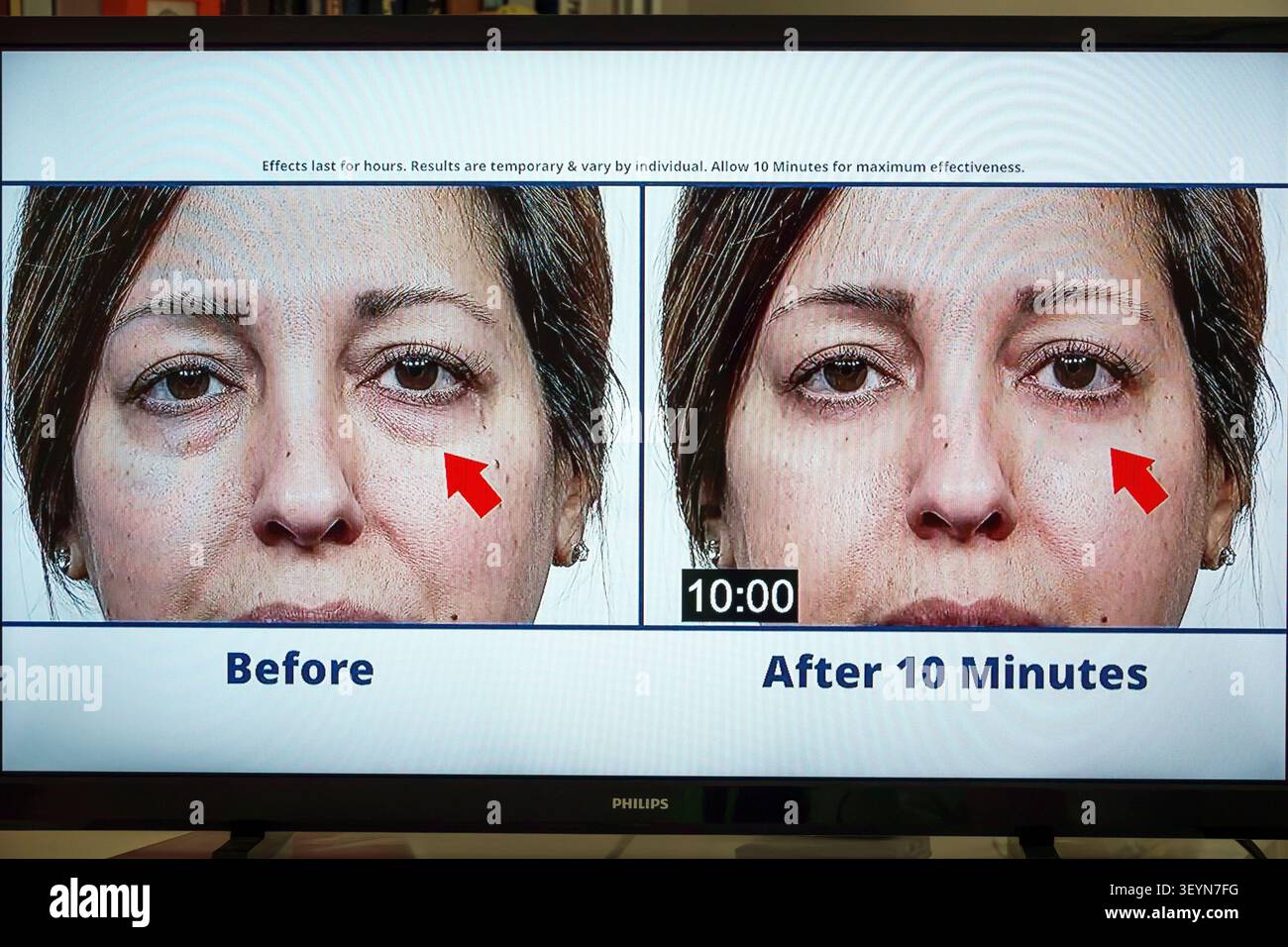 Monitor TV via cavo, prima e dopo, confronto prima-dopo, donna adulta, volto di donna, primo piano, pelle del viso, occhi, sotto gli occhi, sotto Foto Stock
