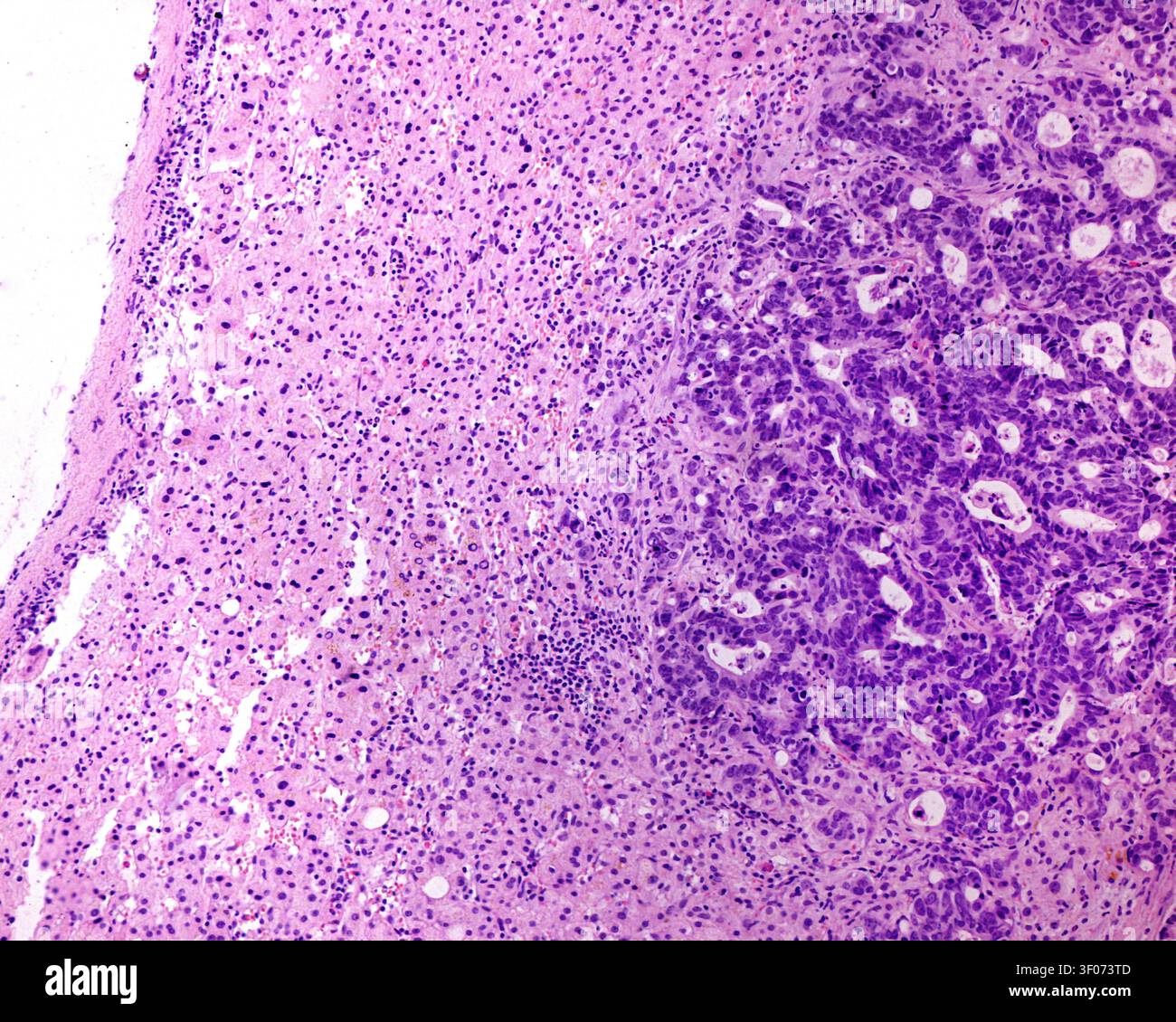 Il fegato è uno dei siti più comuni per la metastasi tumorale, che rappresenta quasi il 25% di tutti i casi, con adenocarcinomi colorettali come il più f Foto Stock