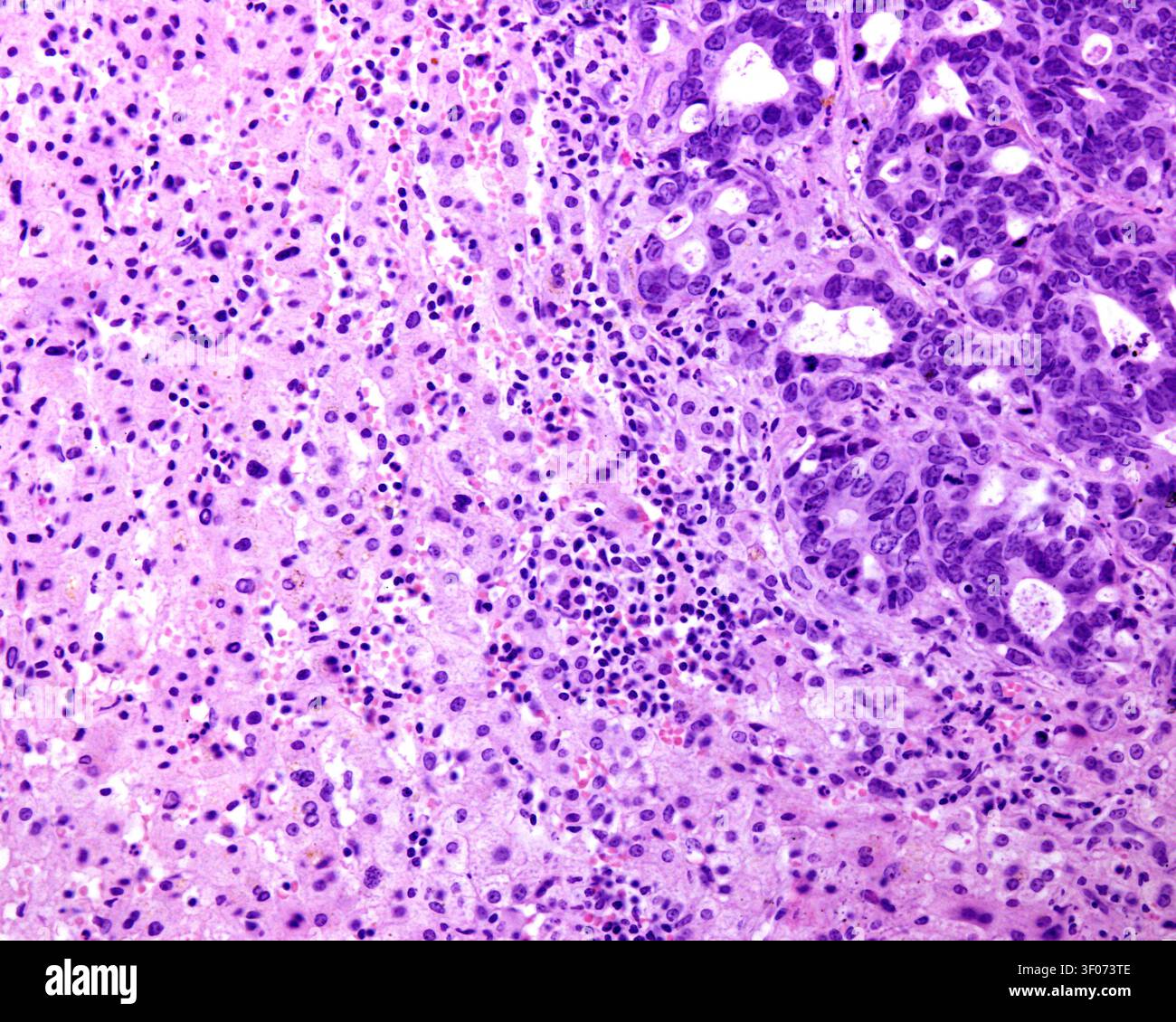Il fegato è uno dei siti più comuni per la metastasi tumorale, che rappresenta quasi il 25% di tutti i casi, con adenocarcinomi colorettali come il più f Foto Stock