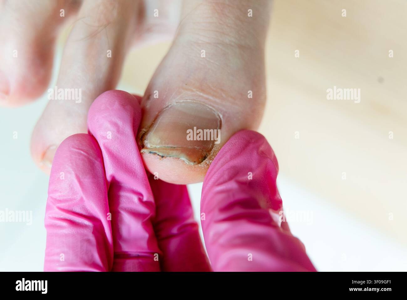 Prima di un medico che tratta un'unghia danneggiata su un alluce con unghia infetta visibile. Un medico preoccupato che tiene l'alluce ferito esamina la dolorosa lesione dell'unghia in una clinica di podologia sterile. Foto Stock