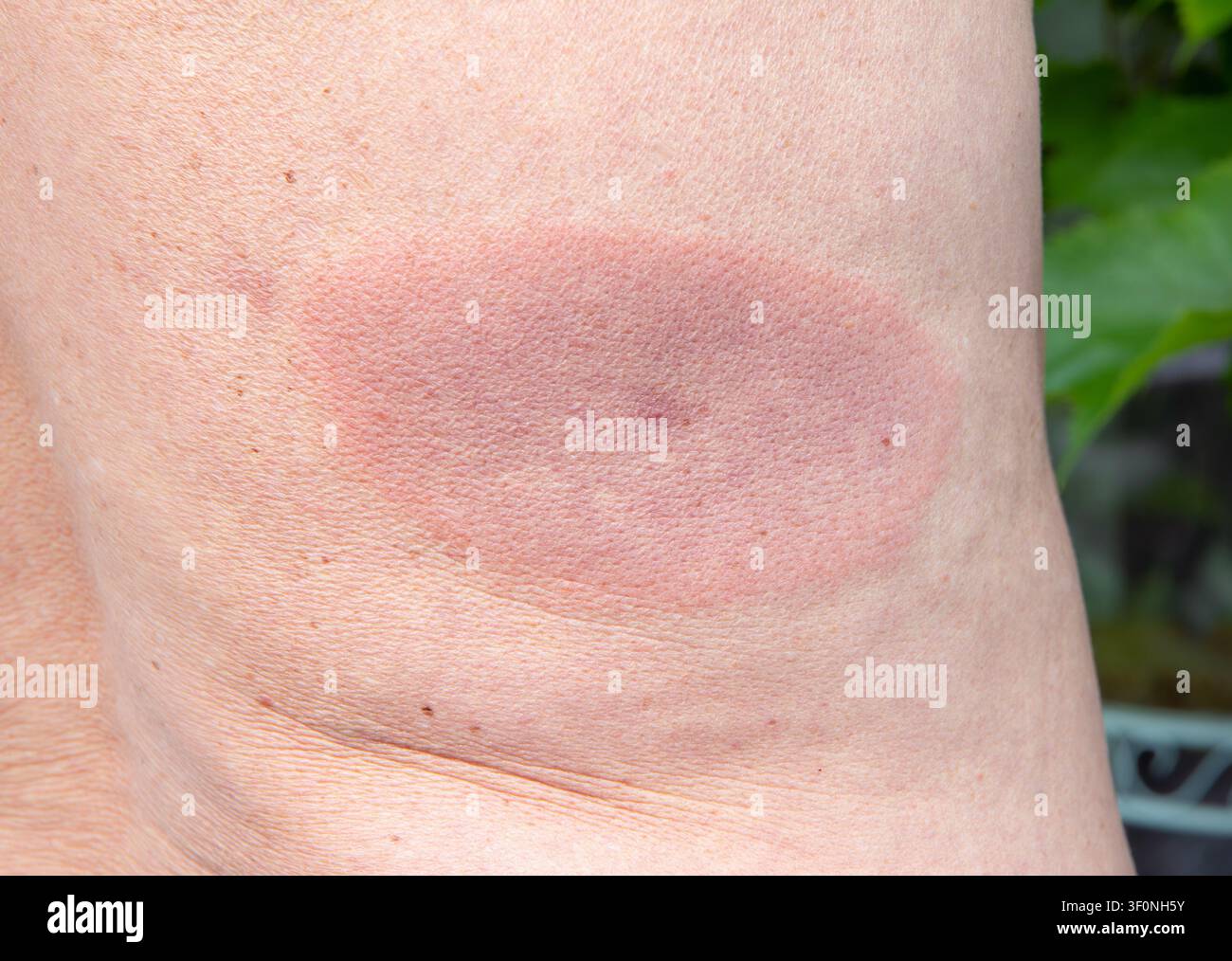 Malattia di Lyme, nota anche come borreliosi di Lyme, macchia rossa sul dorso di un uomo adulto. La borreliosi è una malattia trasmessa dalle zecche. Macchia vecchia di circa una settimana. Foto Stock