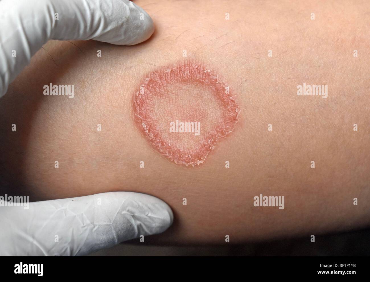 Placca classica circolare, squamosa ed eritematica di tigna sulla pelle Foto Stock