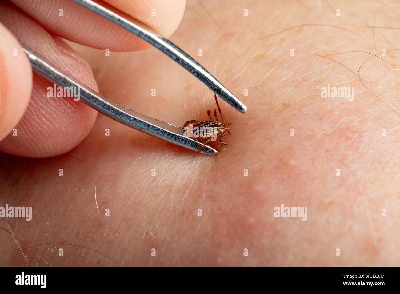 Pinzette a punta fine che rimuove una zecca dalla pelle umana, dimostrando la tecnica di primo soccorso raccomandata. Foto Stock