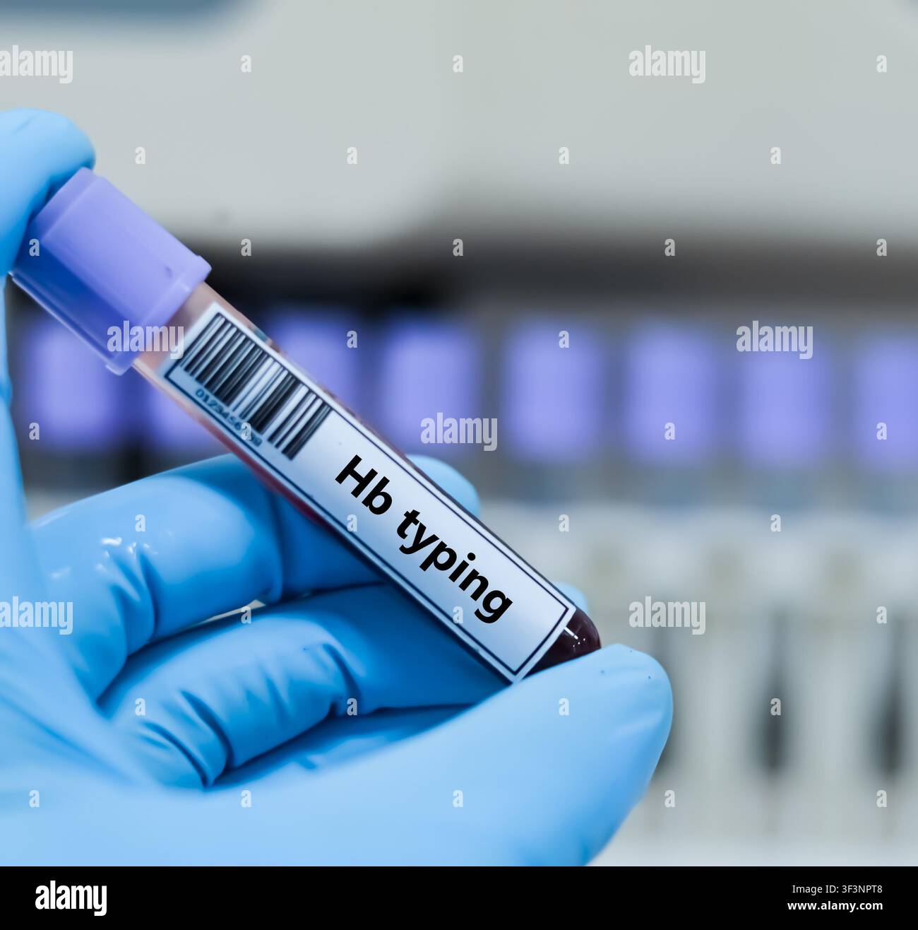 Tubo per campioni di sangue per l'analisi del test di tipizzazione Hb. Foto Stock