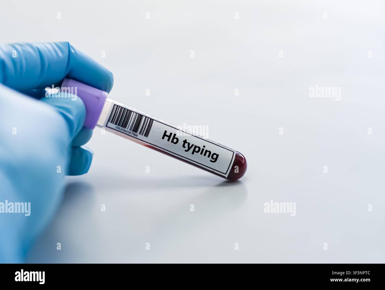 Tubo per campioni di sangue per l'analisi del test di tipizzazione Hb. Foto Stock