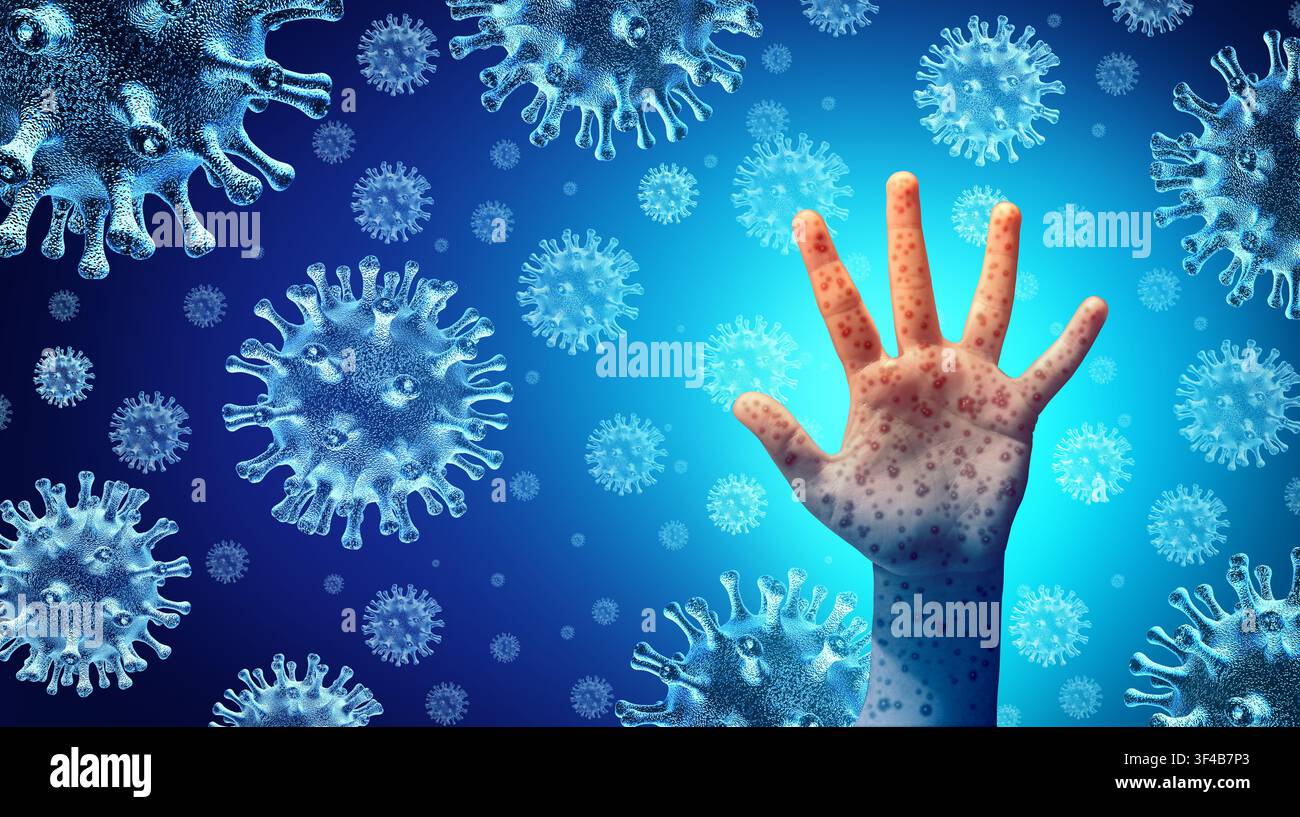 I casi di morbillo in aumento sono collegati al calo dei tassi di vaccinazione, illustrando la diffusione del virus altamente contagioso della rosolia come una crisi sanitaria pubblica wi Foto Stock