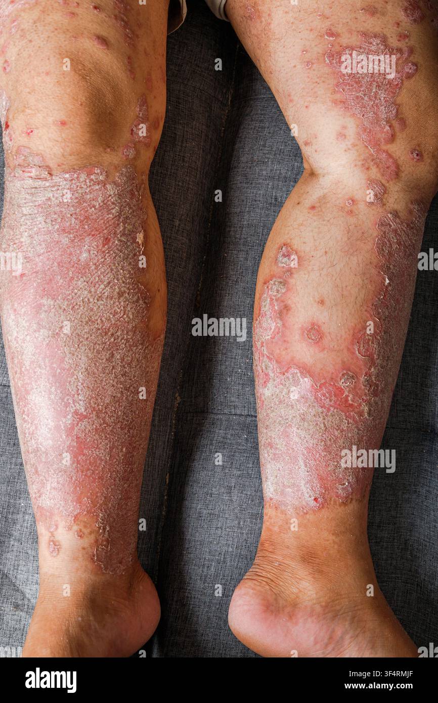 Prima vista di pelle secca e squamosa infiammata su una gamba umana, Una condizione cutanea cronica con arrossamento, irritazione e texture squamosa per l'assistenza sanitaria e la dermatologia Foto Stock