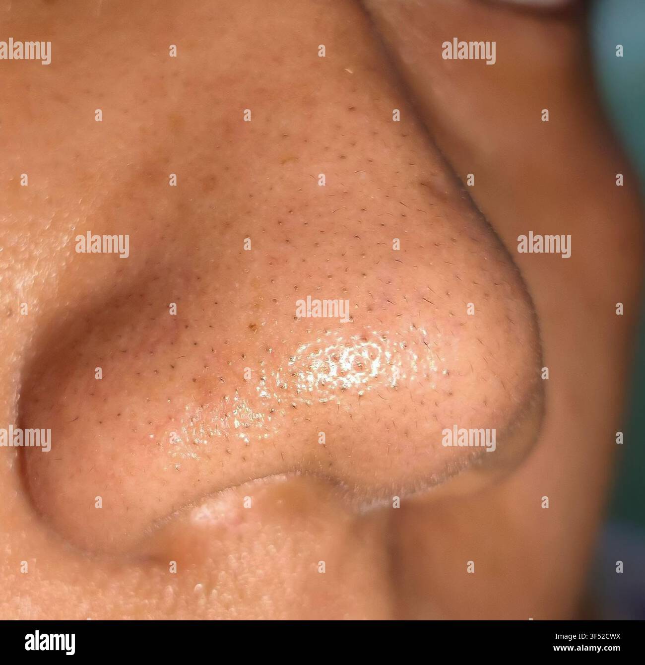 Struttura della pelle grassa con punti neri visibili e pori aperti ostruiti sul naso umano. Foto Stock