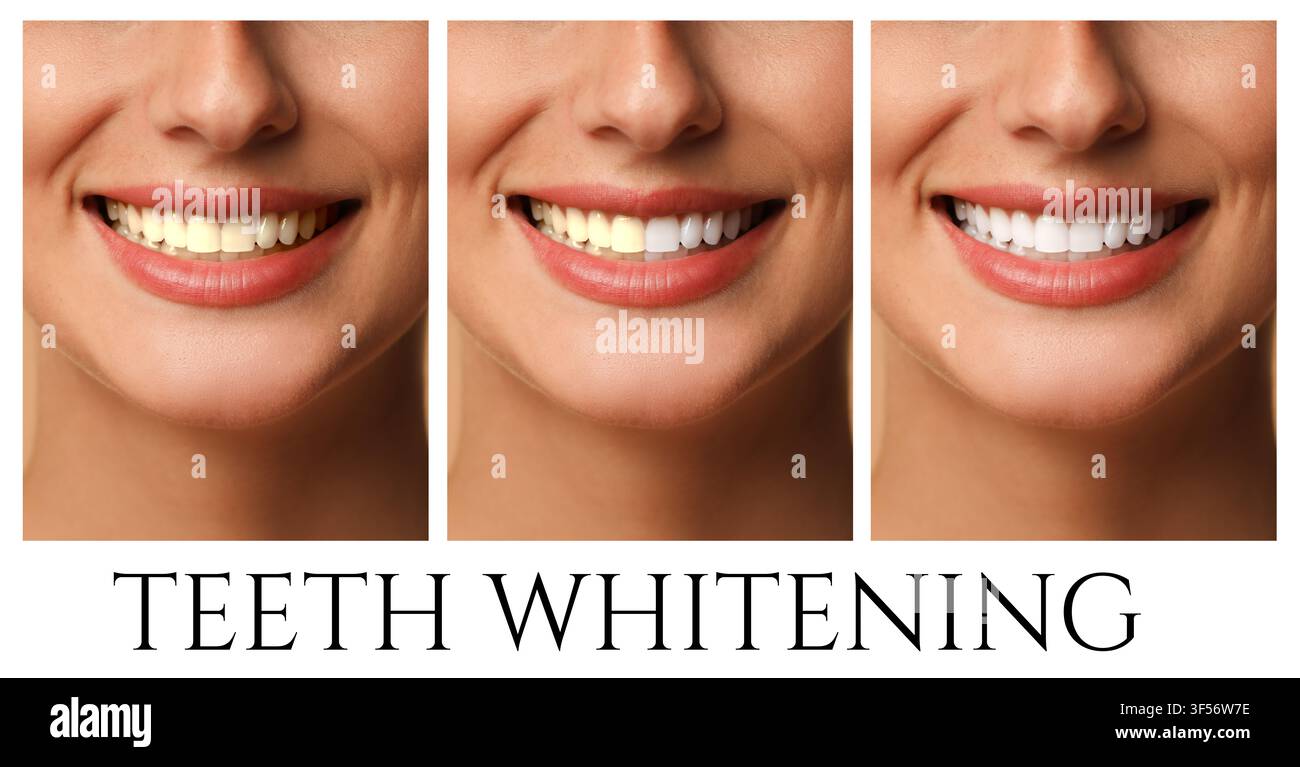 Sbiancamento dei denti, collage. Donna sorridente prima e dopo la procedura, primo piano Foto Stock