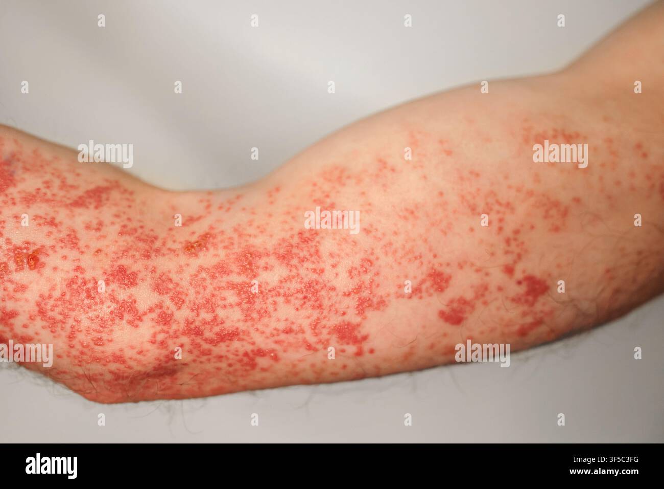 Primo piano di un braccio umano che mostra un grave eritema cutaneo con protuberanze rosse e irritazione. Herpes zoster o infezione da herpes zoster, condizione medica dermatologica dolorosa, sintomi di una malattia virale Foto Stock