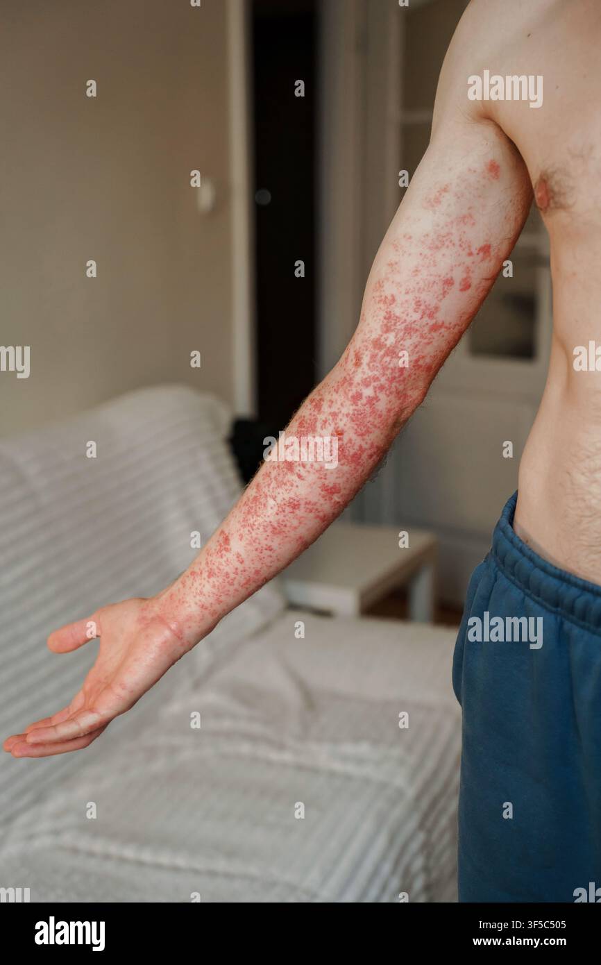 Braccio umano che mostra un grave eruzione cutanea con protuberanze rosse e irritazione. Herpes zoster o infezione da herpes zoster, condizione medica dermatologica dolorosa, sintomi di una malattia virale Foto Stock