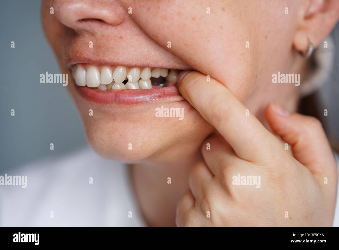 Primo piano di una donna che indica con il dito una lacuna nei denti dove manca un dente, evidenziando problemi di salute orale, consultazione dentale, estrazione del dente o necessità di impianto Foto Stock