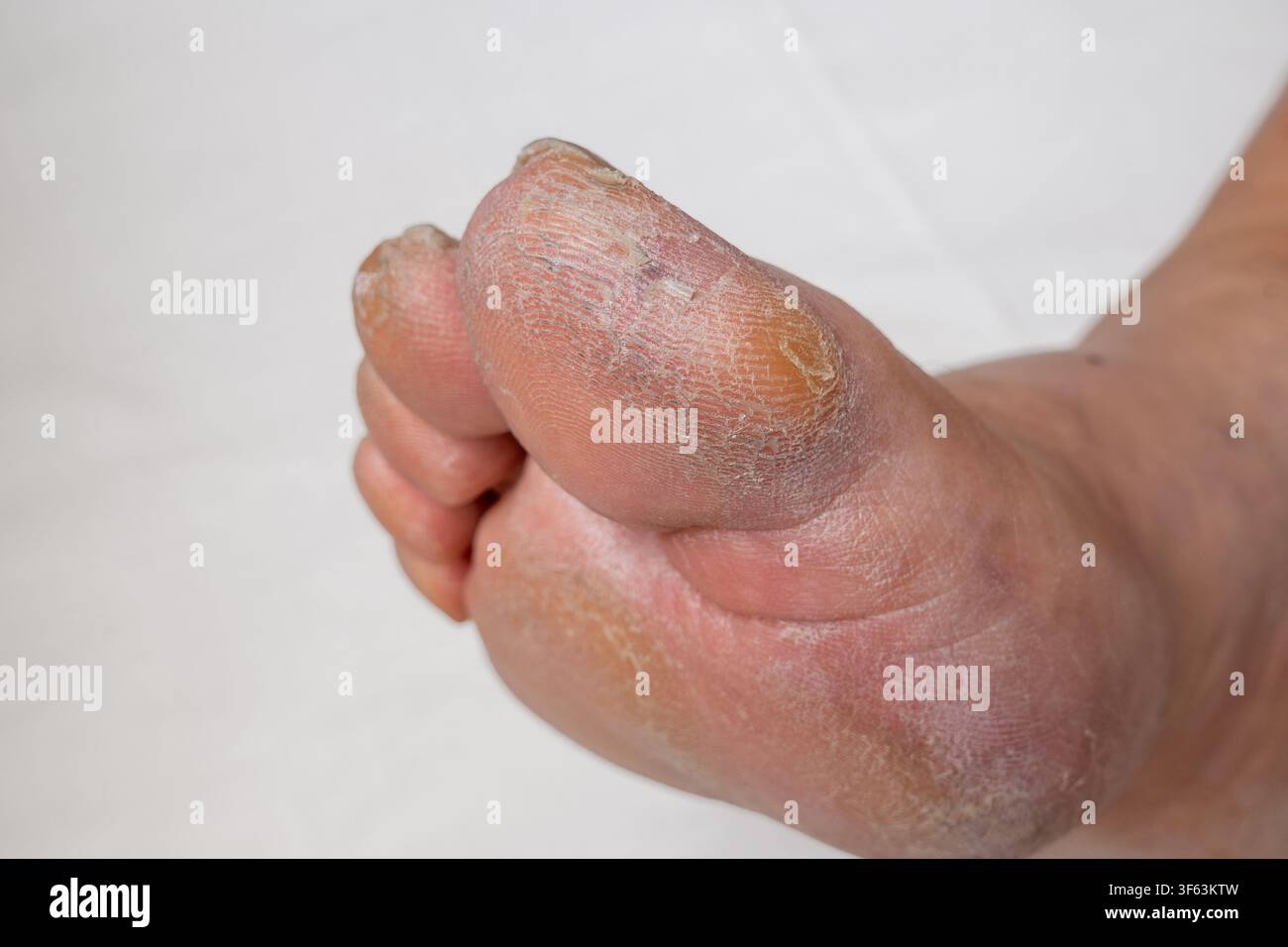 Prima vista di un piede maschile con callo sull'alluce su sfondo bianco Foto Stock