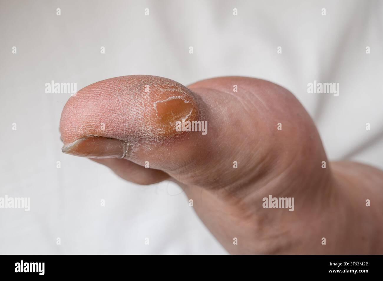 Prima vista di un piede maschile con callo sull'alluce su sfondo bianco Foto Stock