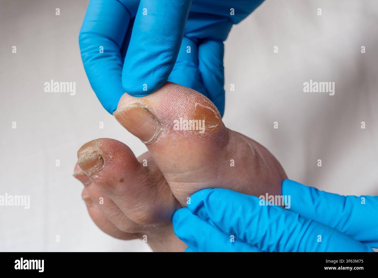 Professionale sanitario che esamina una callosità sull'alluce maschile con guanti medici blu Foto Stock