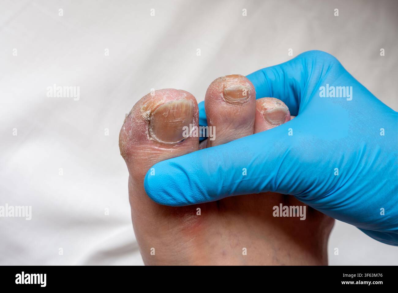 Esame podiatrico del piede maschile con unghia del piede con guanti medici Foto Stock