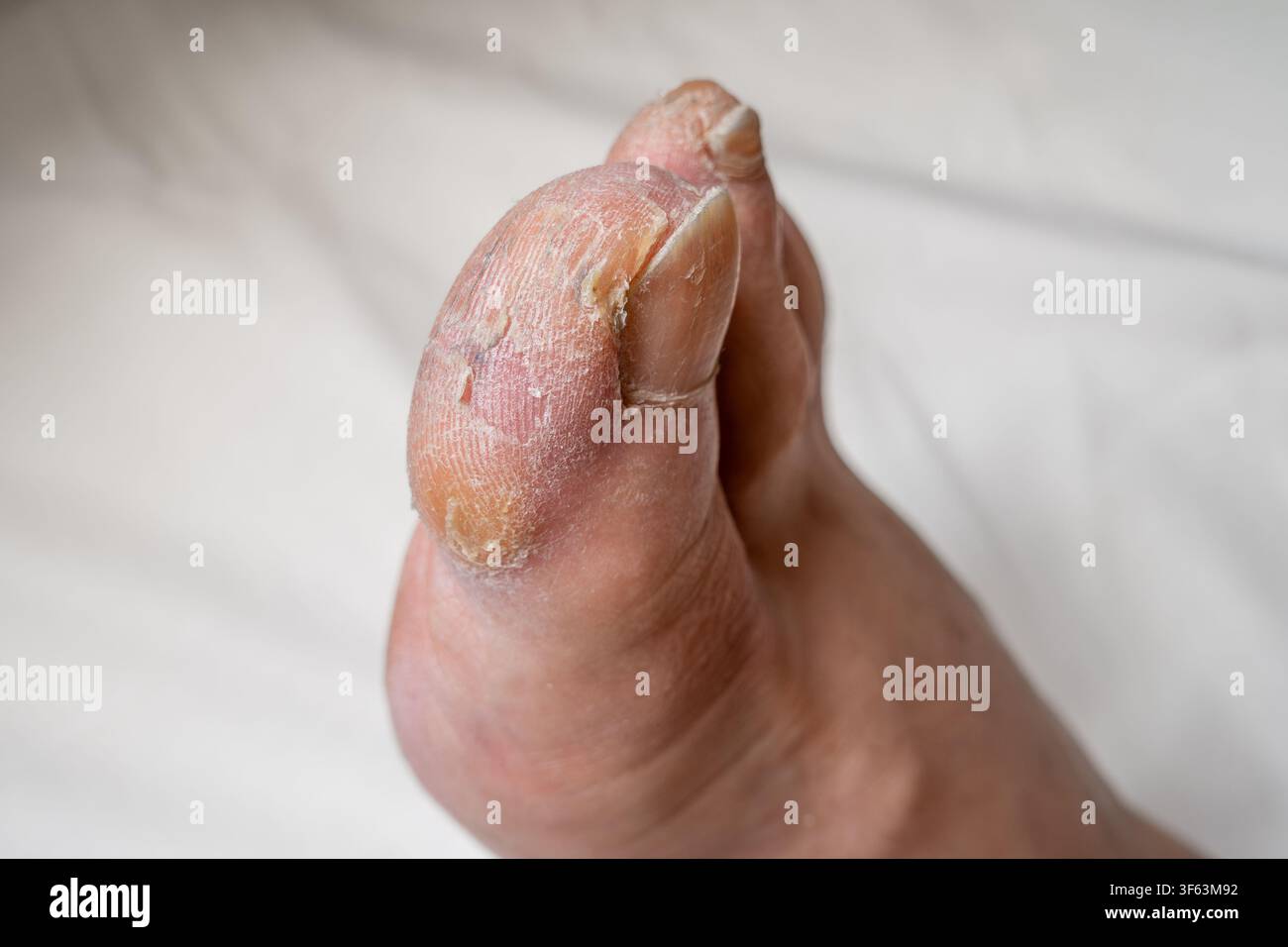 Prima vista di un piede maschile con callo sull'alluce su sfondo bianco Foto Stock