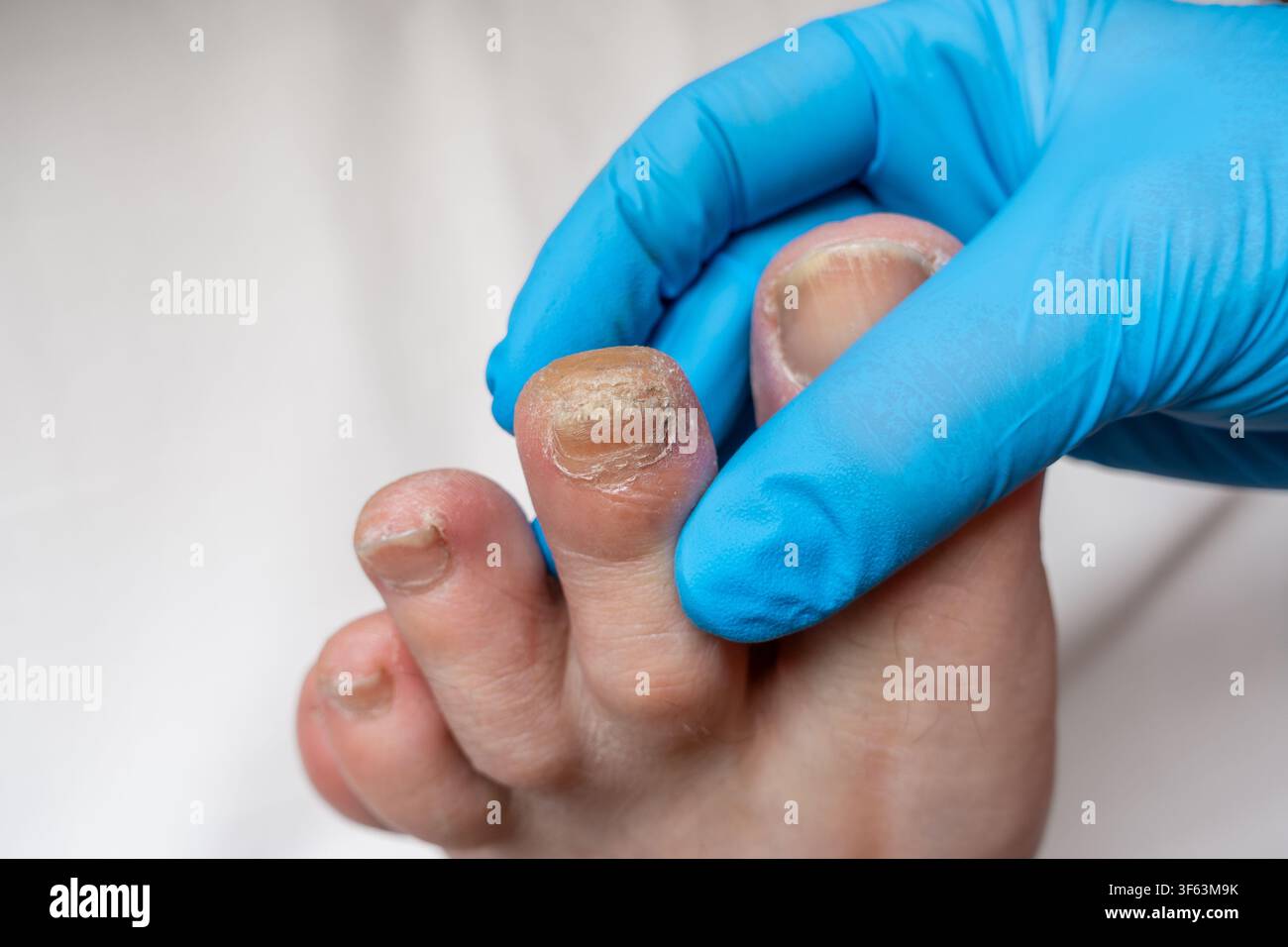 Esame podiatrico del piede maschile con unghia del piede con guanti medici Foto Stock