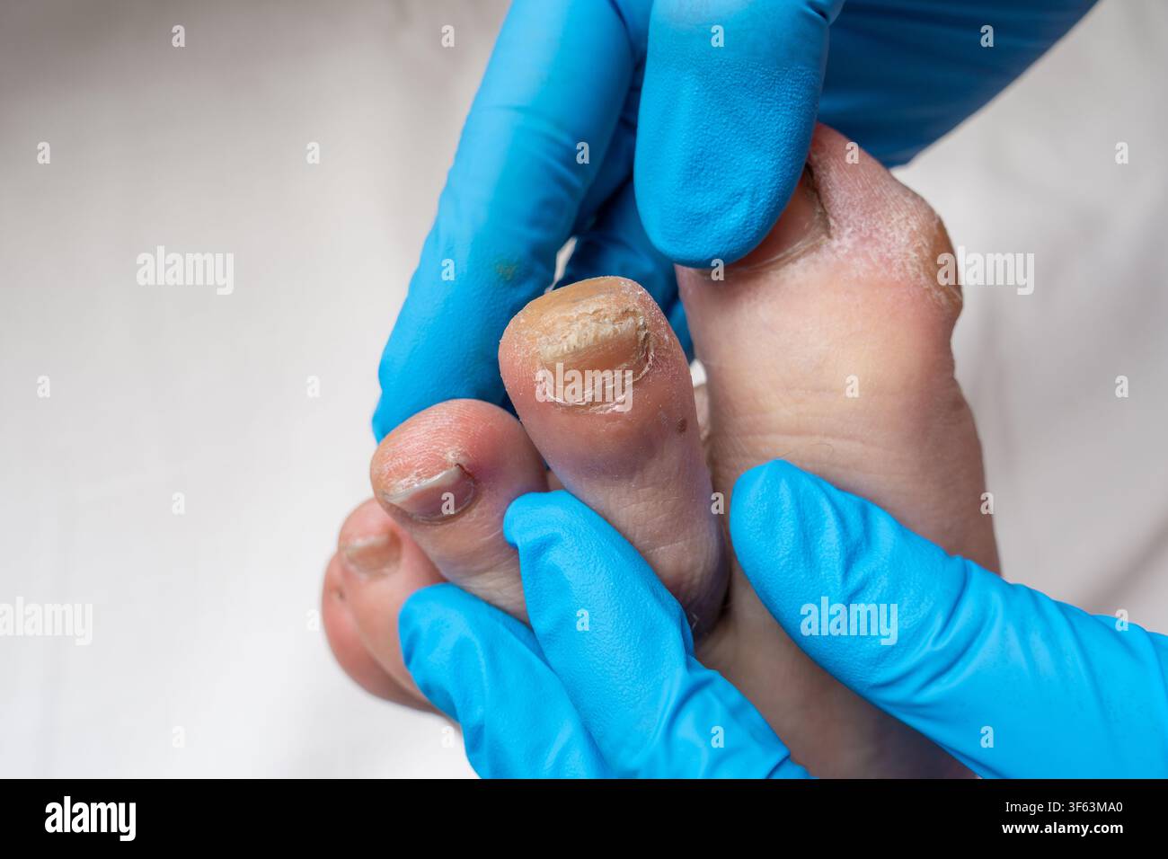 Esame podiatrico del piede maschile con unghia del piede con guanti medici Foto Stock