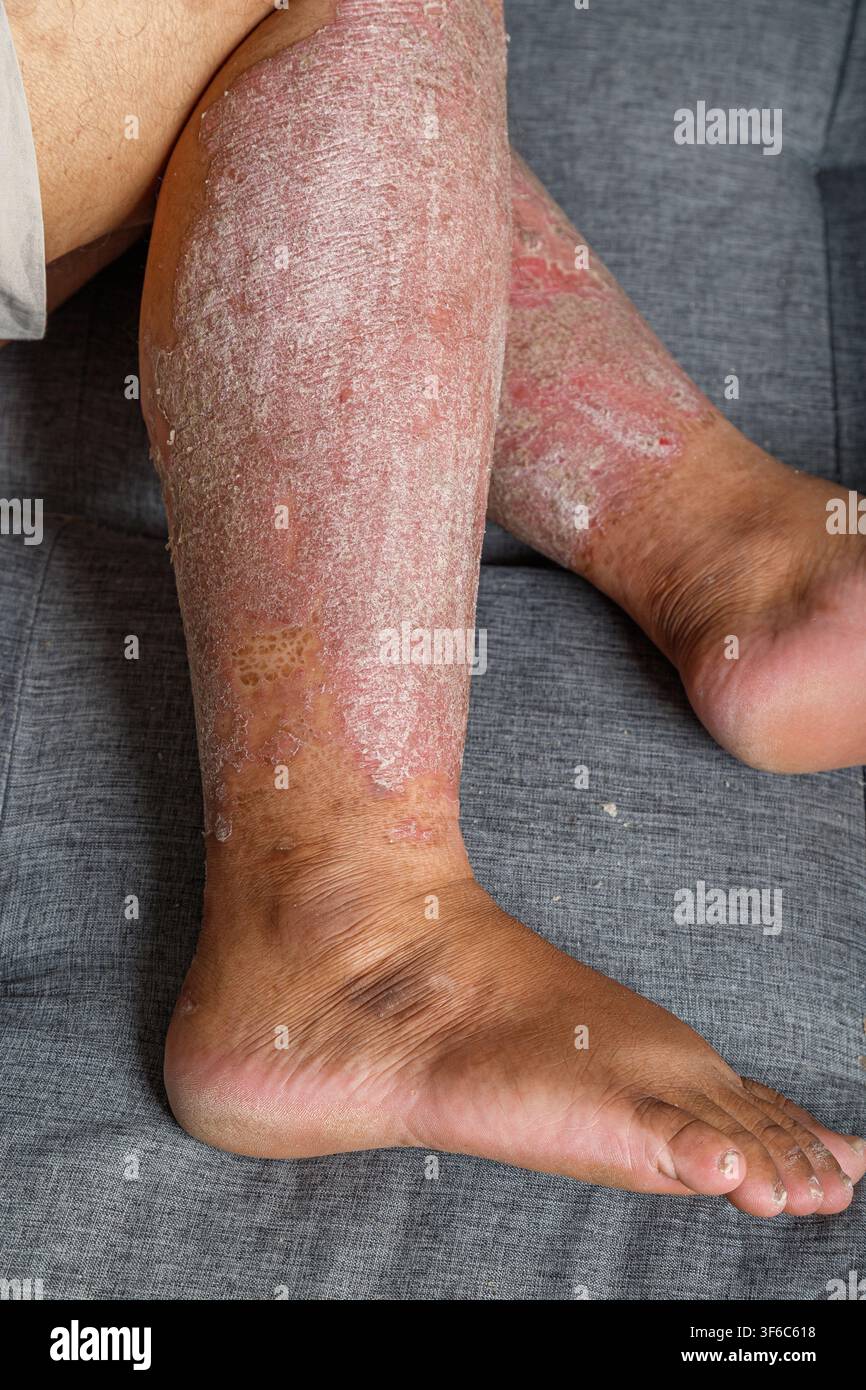 Prima vista di pelle secca e squamosa infiammata su una gamba umana, Una condizione cutanea cronica con arrossamento, irritazione e texture squamosa per l'assistenza sanitaria e la dermatologia Foto Stock