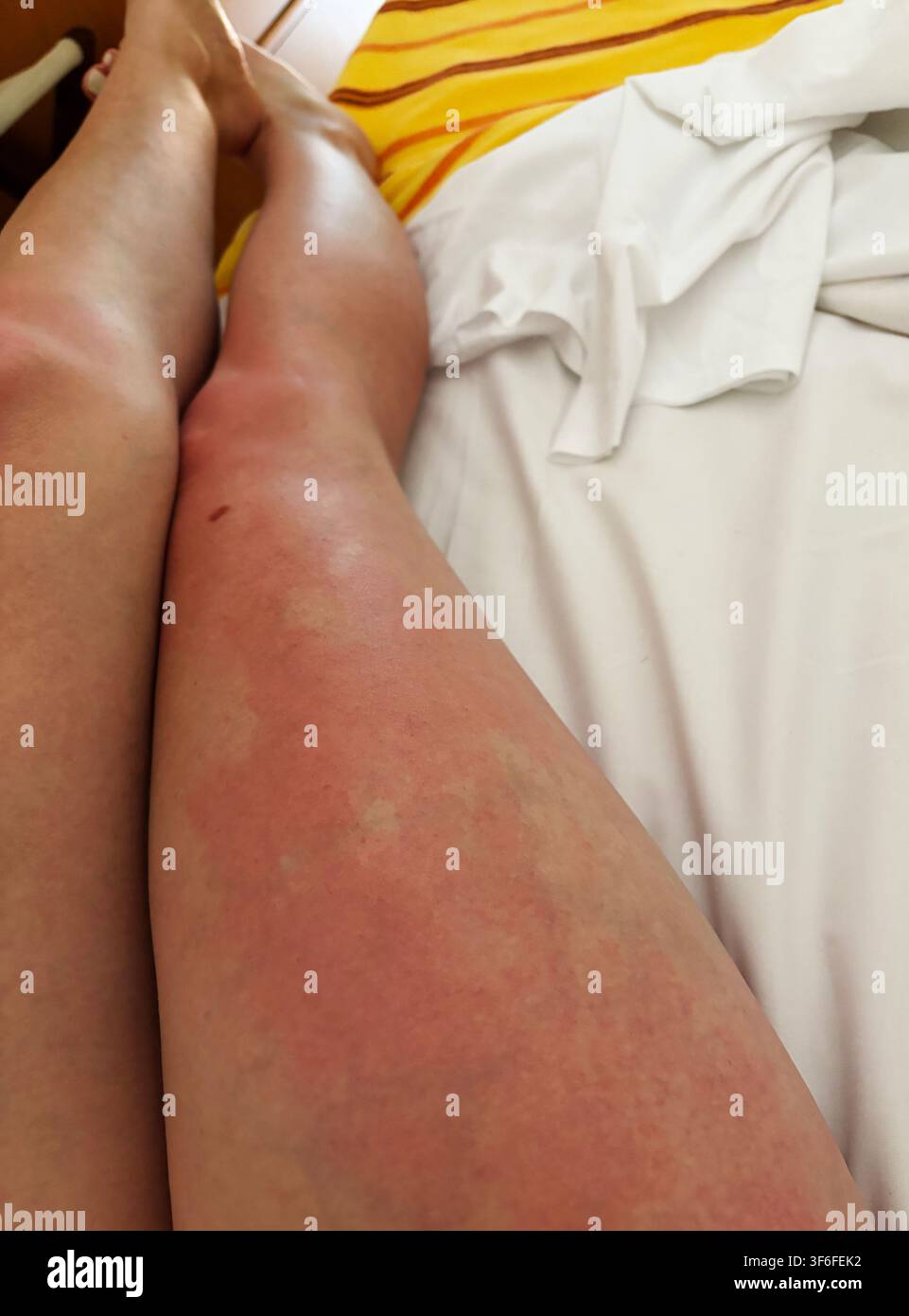 Graffigna scottatura solare con arrossamento cutaneo e abbronzatura irregolare sulle gambe umane dopo un'esposizione eccessiva al sole durante le vacanze estive. Foto Stock
