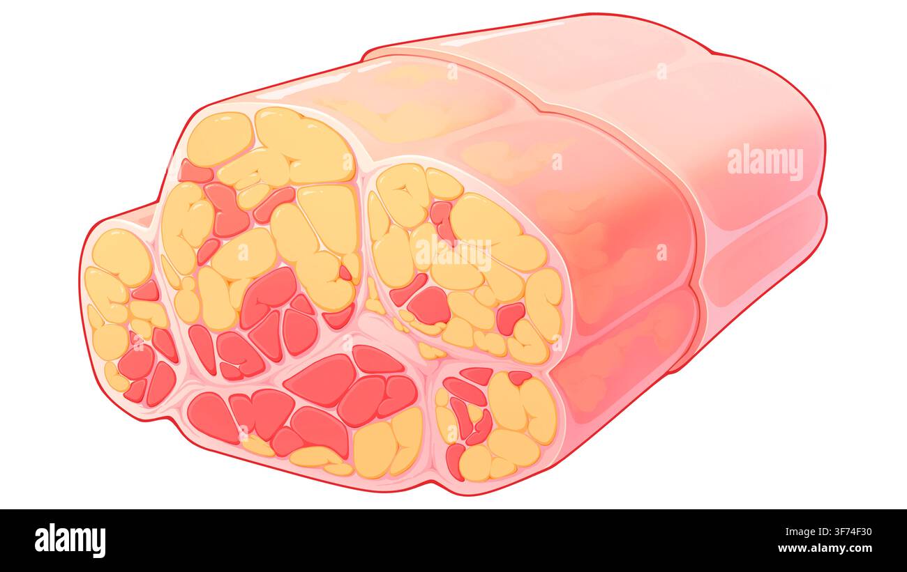 Illustrazione trasversale che mostra un'infiltrazione grassa muscolare di grado 4 secondo Goutallier. L'immagine mostra un'estesa sostituzione del muscolo normale con depositi di grasso, con il volume del grasso che supera significativamente quello delle fibre muscolari residue, esibendo così le caratteristiche della degenerazione grassa avanzata. Tali cambiamenti patologici sono frequentemente osservati nelle lacere tendinee croniche o nell'atrofia da disuso prolungato e possono portare a un'impairment sostanziale della funzione muscolare. Foto Stock