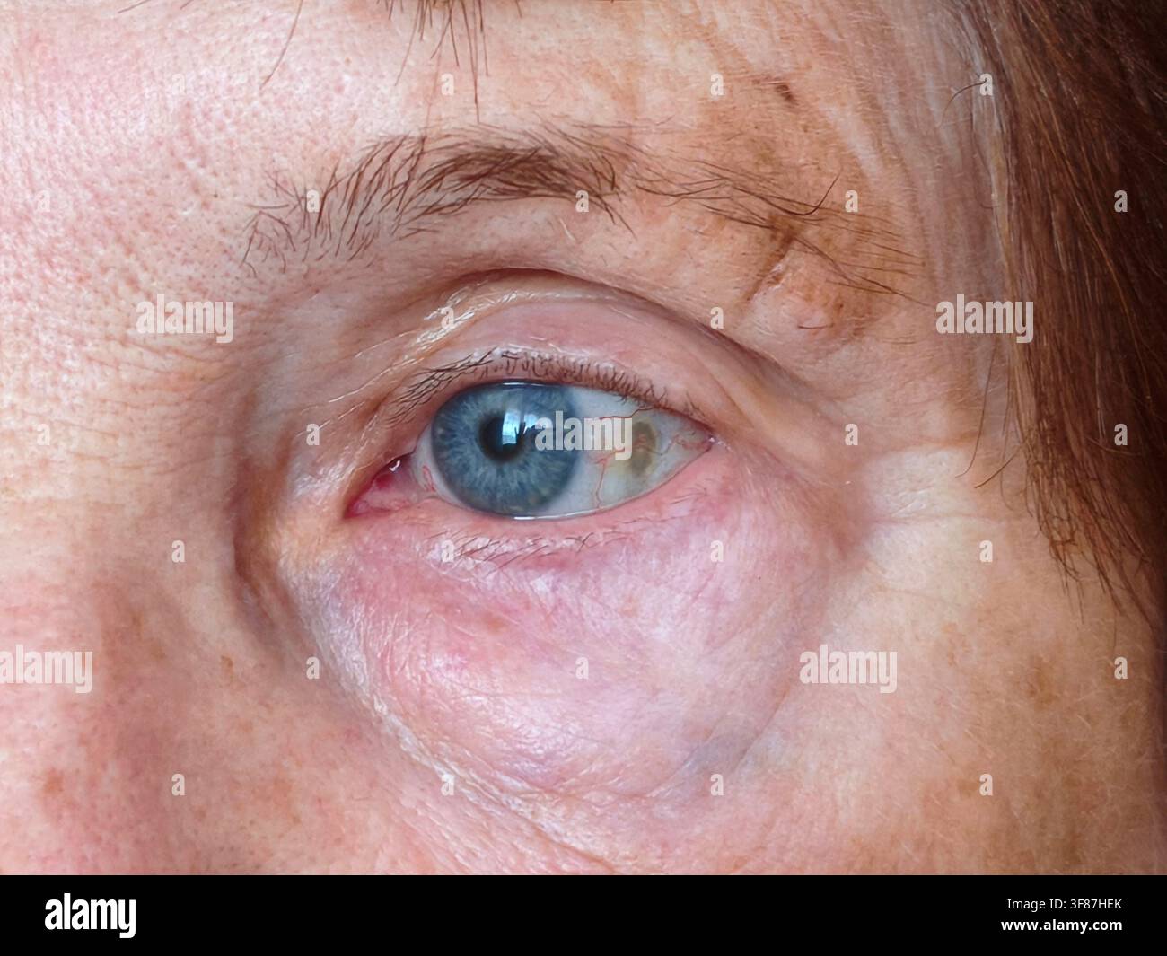 L'occhio blu di una donna anziana con sclera leggermente giallastra e capillari rossi visibili - Immagine stock catturata con smartphone