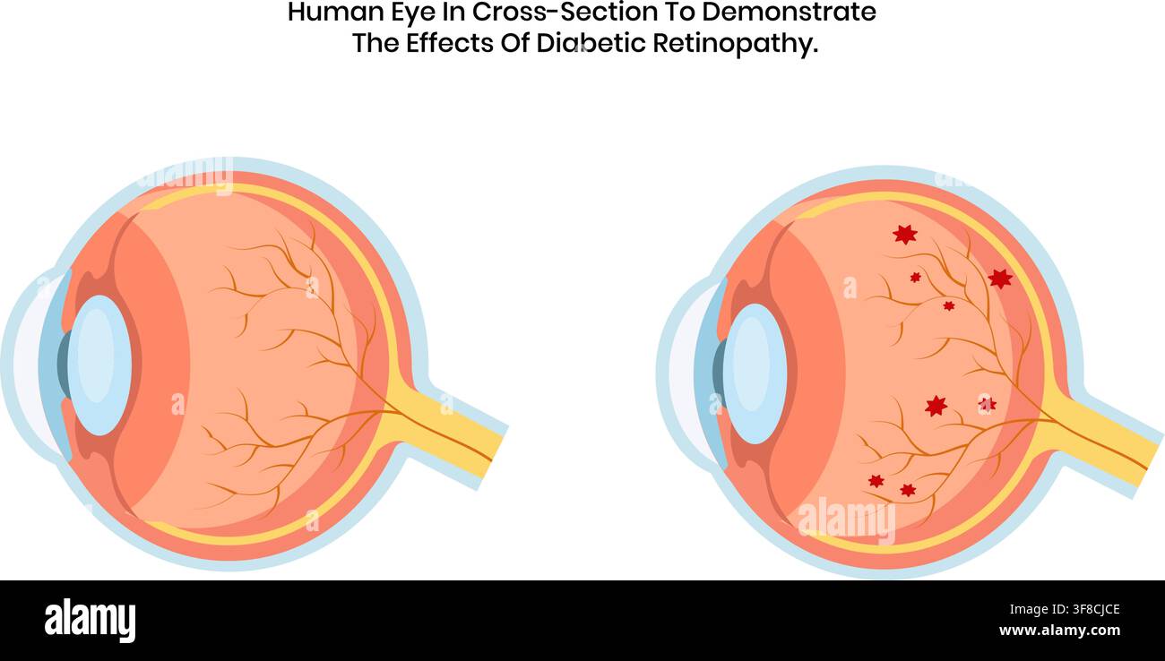 Illustrazione medica di una sezione trasversale dell'occhio umano che confronta una retina normale sana con gli effetti dannosi gravi della malattia della retinopatia diabetica Illustrazione Vettoriale