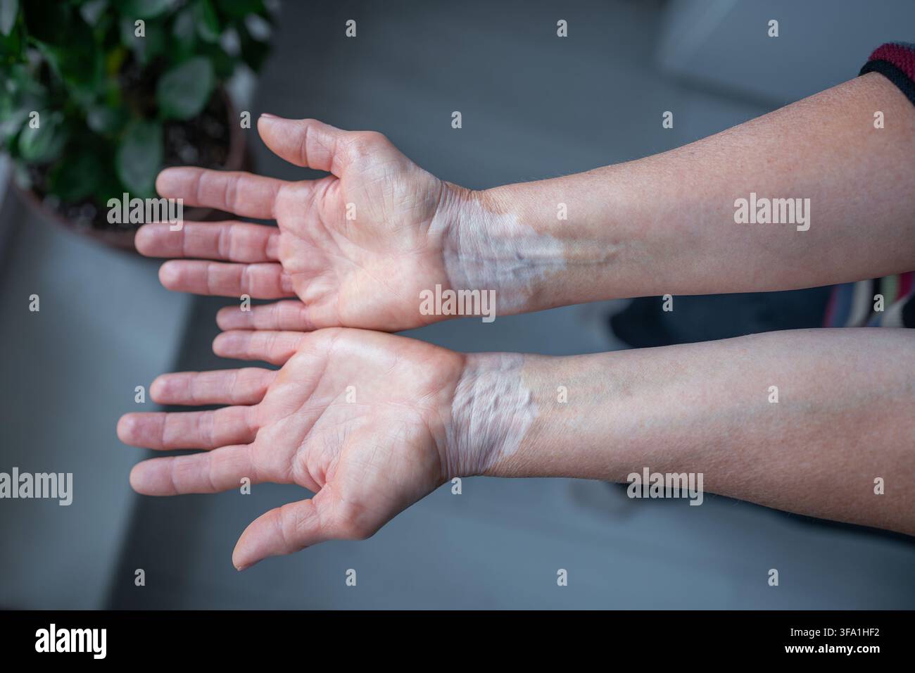 Primo piano di mani con vitiligine che mostrano visibile depigmentazione cutanea, contrasto di pigmentazione naturale. Foto Stock