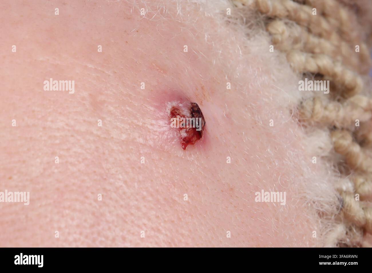 Carcinoma basocellulare della fronte in una donna di 45 anni. Foto Stock