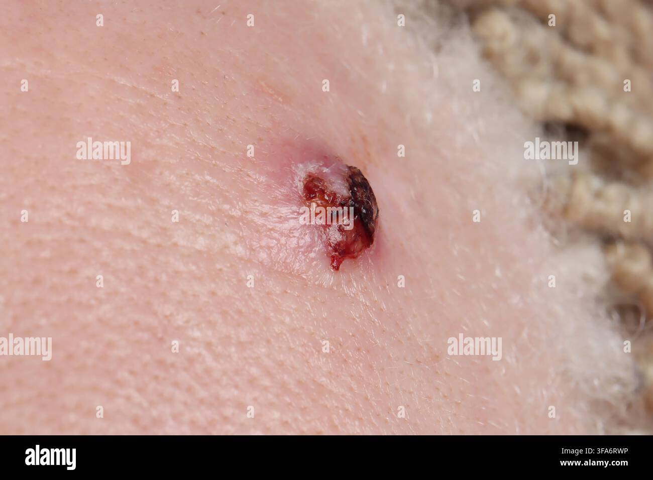 Carcinoma basocellulare della fronte in una donna di 45 anni. Foto Stock
