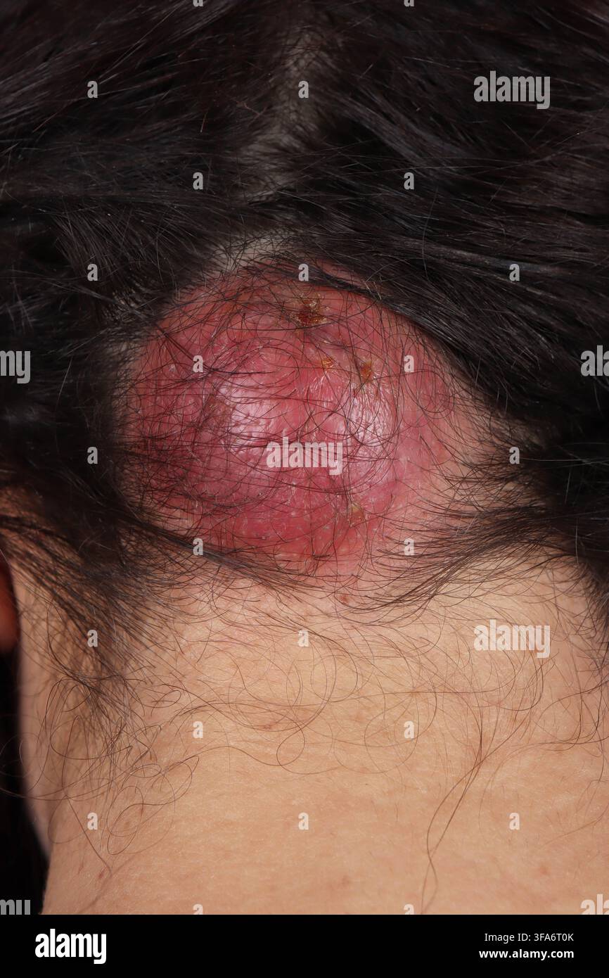 Ciste epidermoide occipitale in una donna di 33 anni. Foto Stock