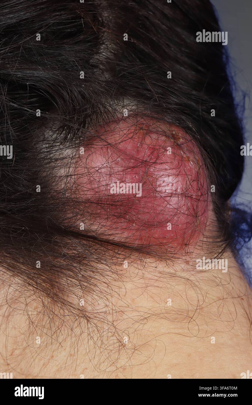 Ciste epidermoide occipitale in una donna di 33 anni. Foto Stock