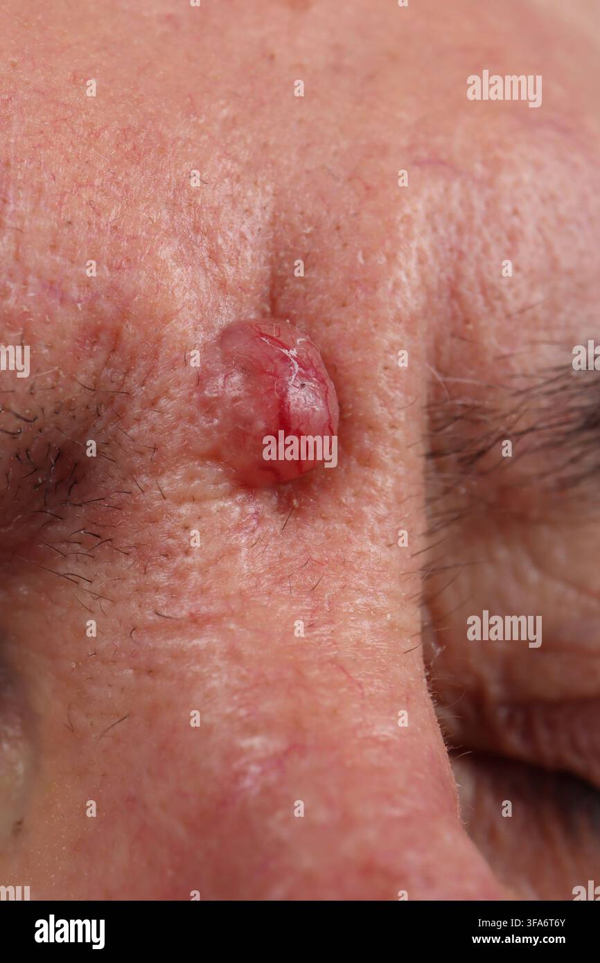 Trichoblastoma della glabella in un uomo di 73 anni. Foto Stock