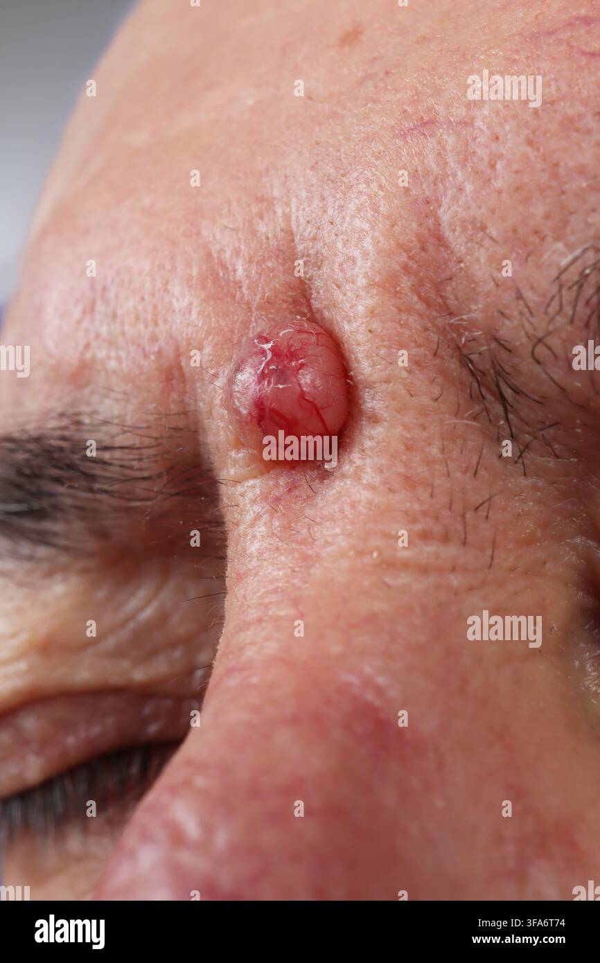 Trichoblastoma della glabella in un uomo di 73 anni. Foto Stock
