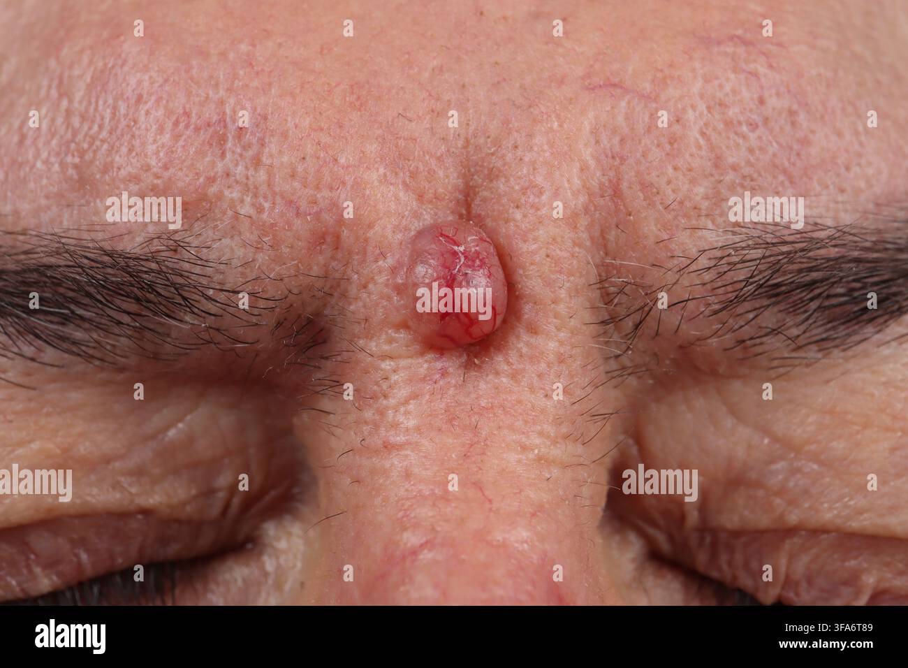 Trichoblastoma della glabella in un uomo di 73 anni. Foto Stock