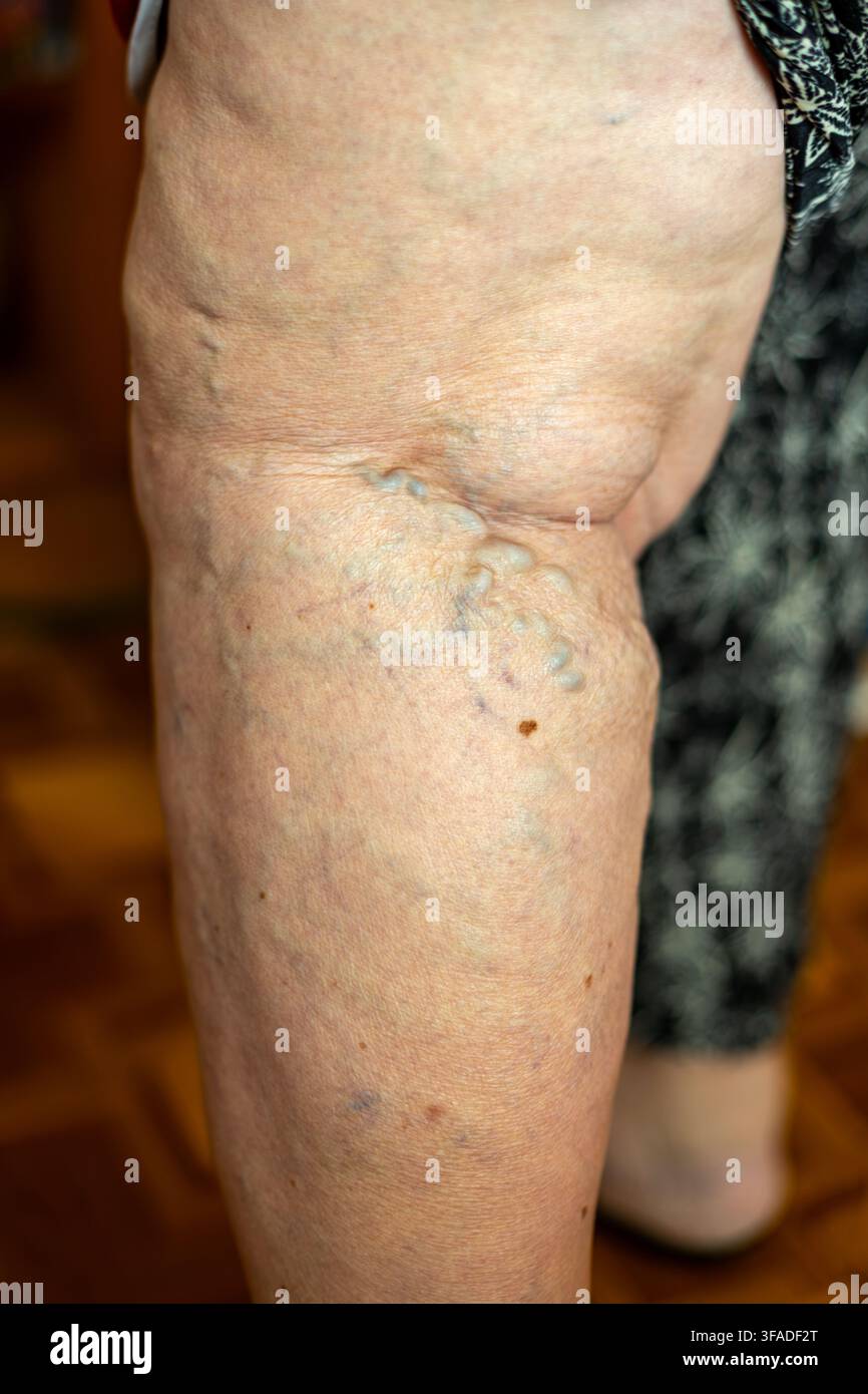 Vene varicose sulla gamba e sul ginocchio di un adulto anziano. Primo piano di una gamba e di un ginocchio di un adulto anziano che mostra vene varicose prominenti, vasi superficiali blu-verdi Foto Stock