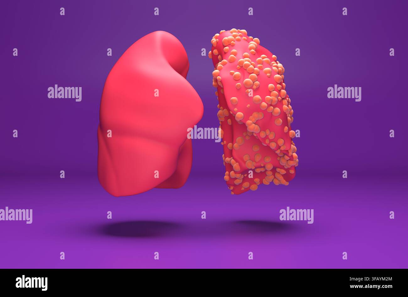 Mesotelioma - illustrazione 3D in vista isometrica Foto Stock