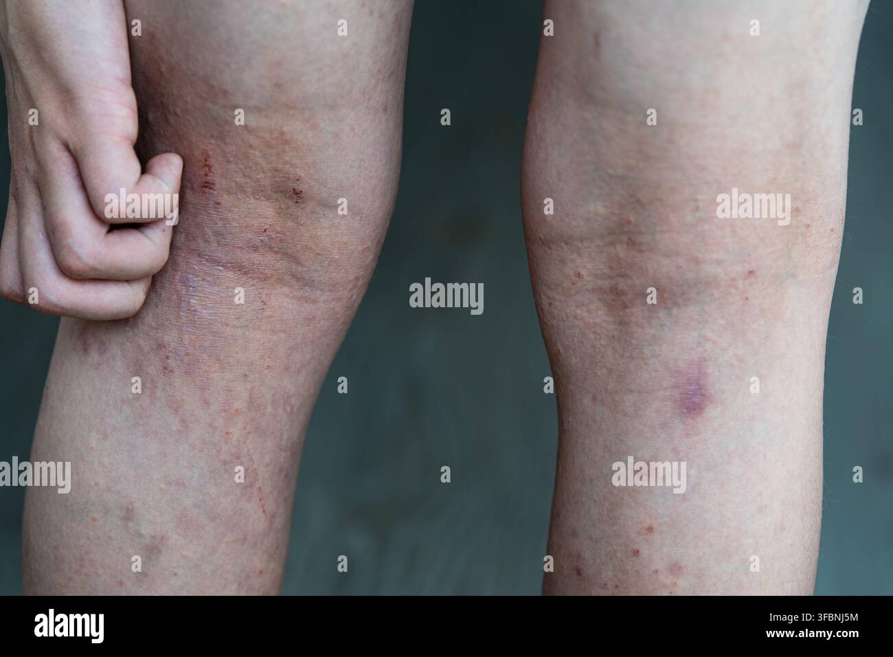 Persona che si gratta le gambe pruriginose con dermatite atopica. Primo piano di una mano sulla pelle rossa irritata con eruzione cutanea, eczema e sintomi di allergia. Foto Stock