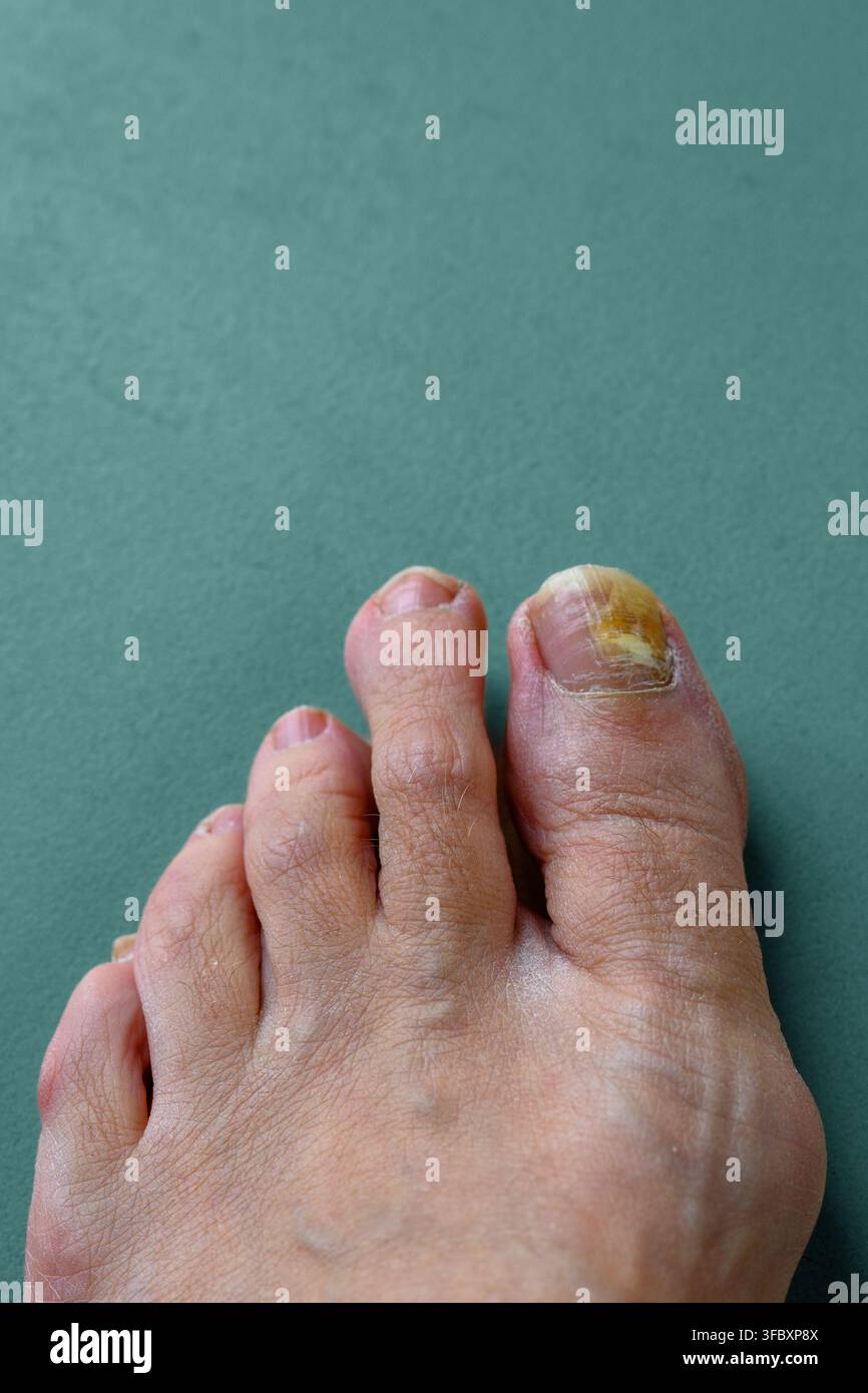 Piede che mostra un’unghia infetta con decolorazione gialla e pelle ispessita. Un dito del piede è visibilmente colpito, mostrando segni di infezione fungina. Il piede poggia su s Foto Stock