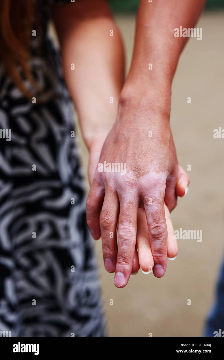 Mani di una persona con vitiligo e del partner che si tengono strette, rappresentando sostegno, accettazione, diversità e relazioni. Foto Stock
