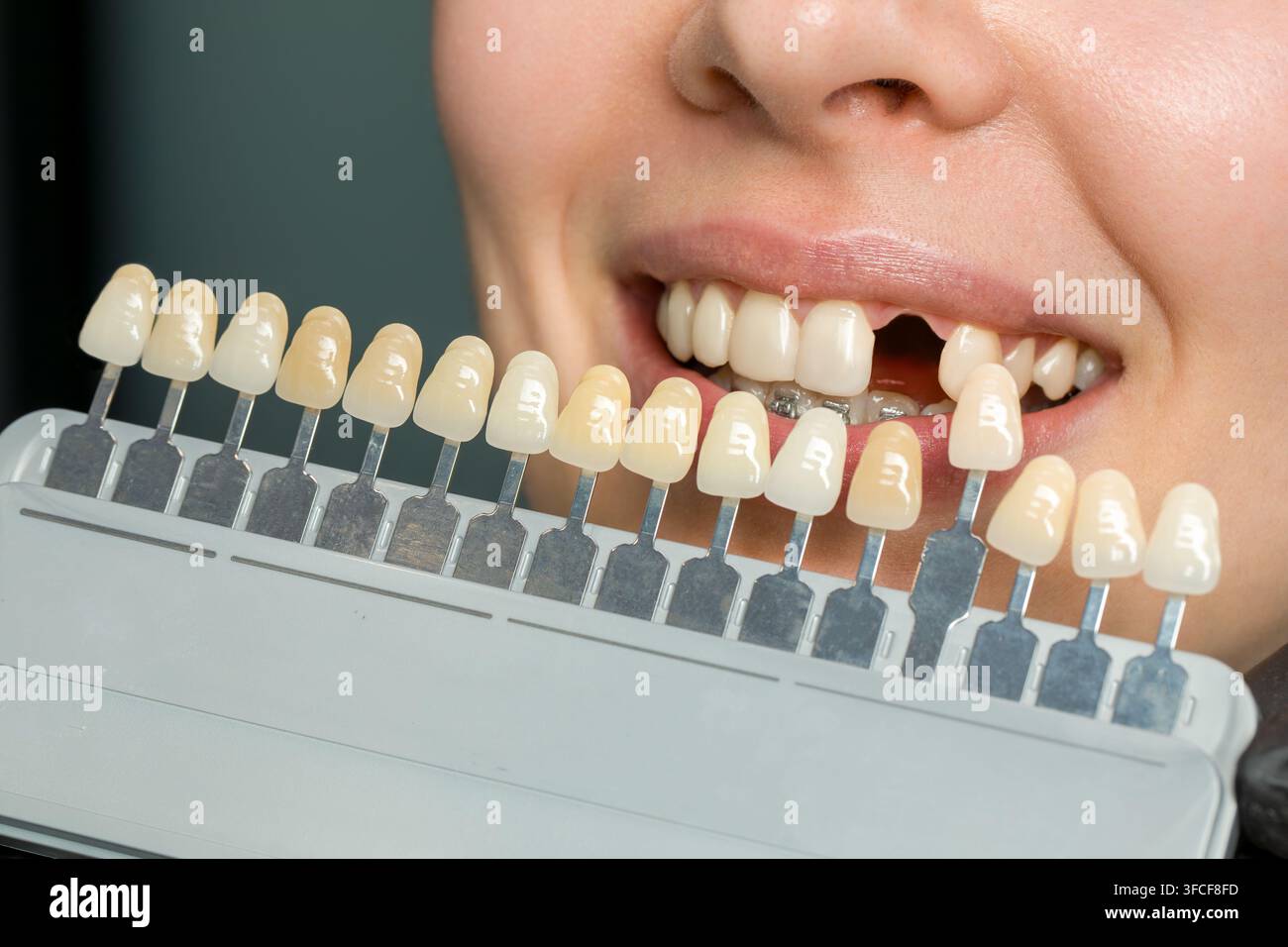 Selezione della tonalità degli impianti dentali in una clinica dentale Foto Stock