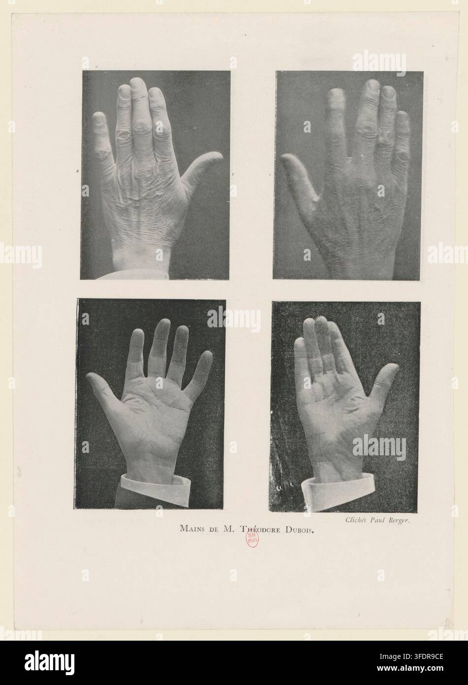 Una fotografia del 1910 di Paul Berger, che mostra quattro vedute delle mani di Théodore Dubois, compositore e organista francese, con la mano posizionata in verticale e le dita estese, indossando una manchetta bianca al polso. Foto Stock