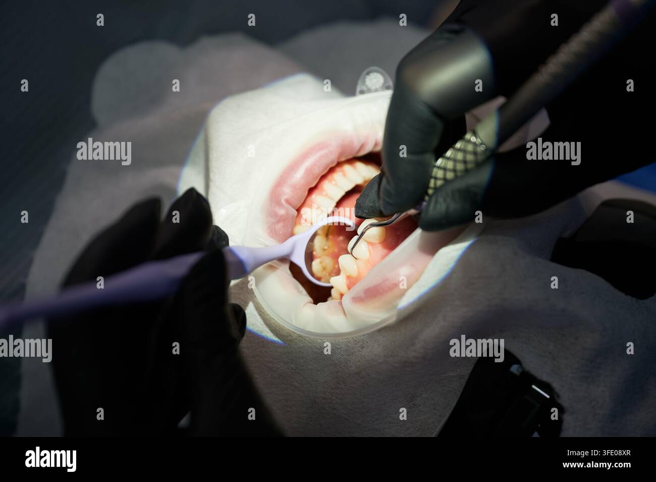 Igienista dentale esegue la rimozione del tartaro durante la procedura di pulizia dei denti. Primo piano dell'esame orale e del trattamento igienico in clinica, profilassi, h Foto Stock