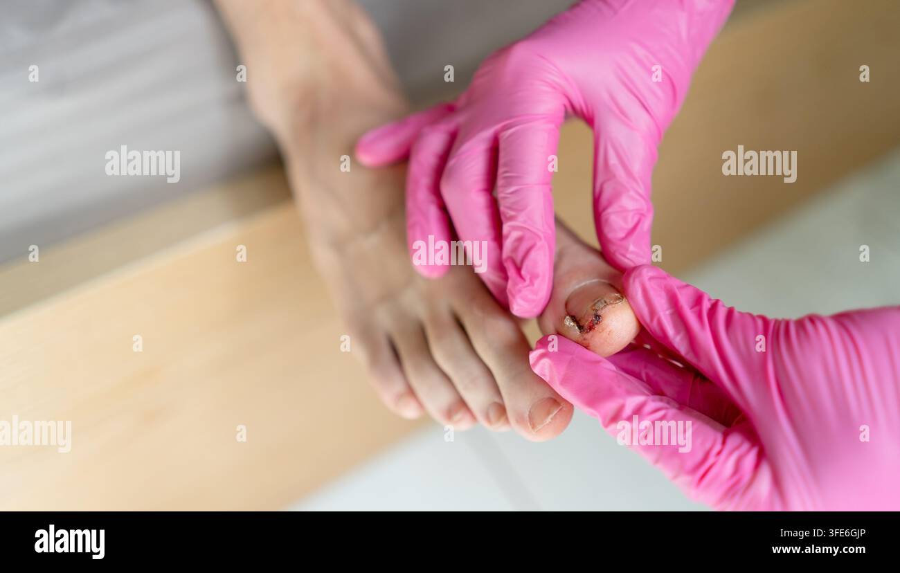 Visto dall'alto, un podologo con guanti rosa esamina un piede e un dito, tenendo la caviglia e l'unghia. Uno specialista calmo tratta la pianta e il tallone diagnosticando il piede del paziente in una clinica di podologia sterile. Foto Stock