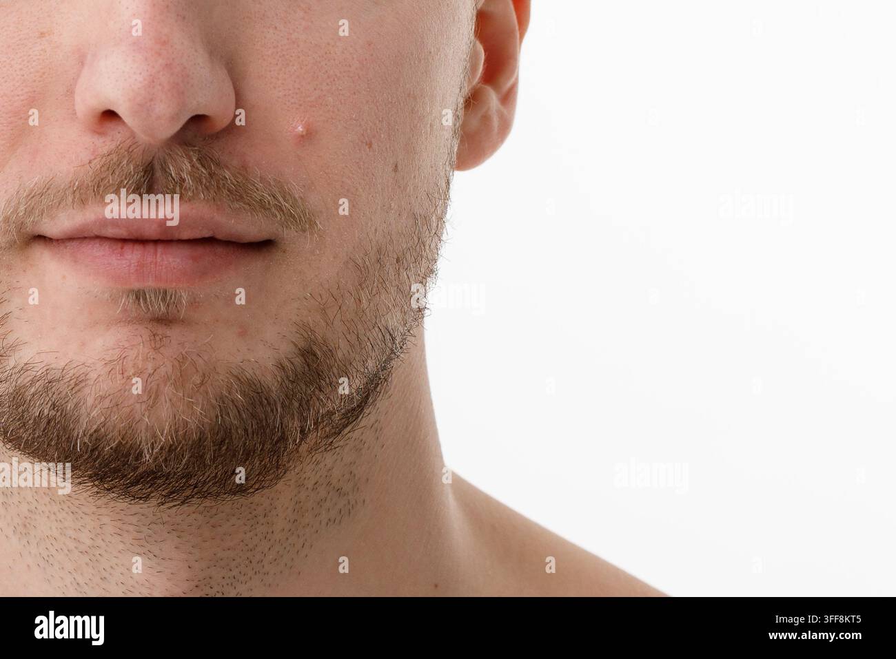 Primo piano della pelle umana con acne e imperfezioni Foto Stock