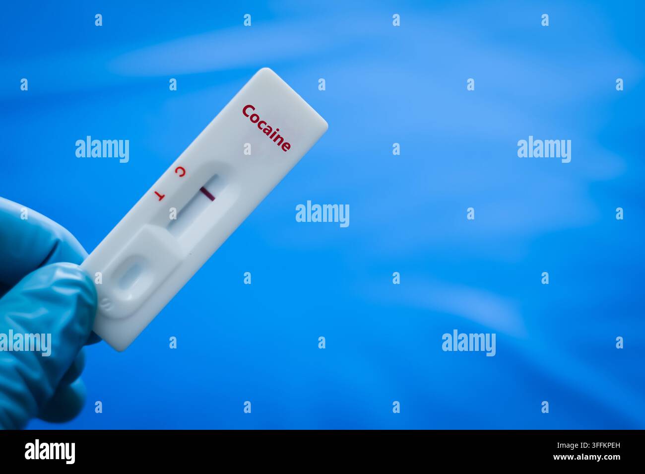 Il tubo di campione del paziente con risultato positivo per cocaina. Foto Stock