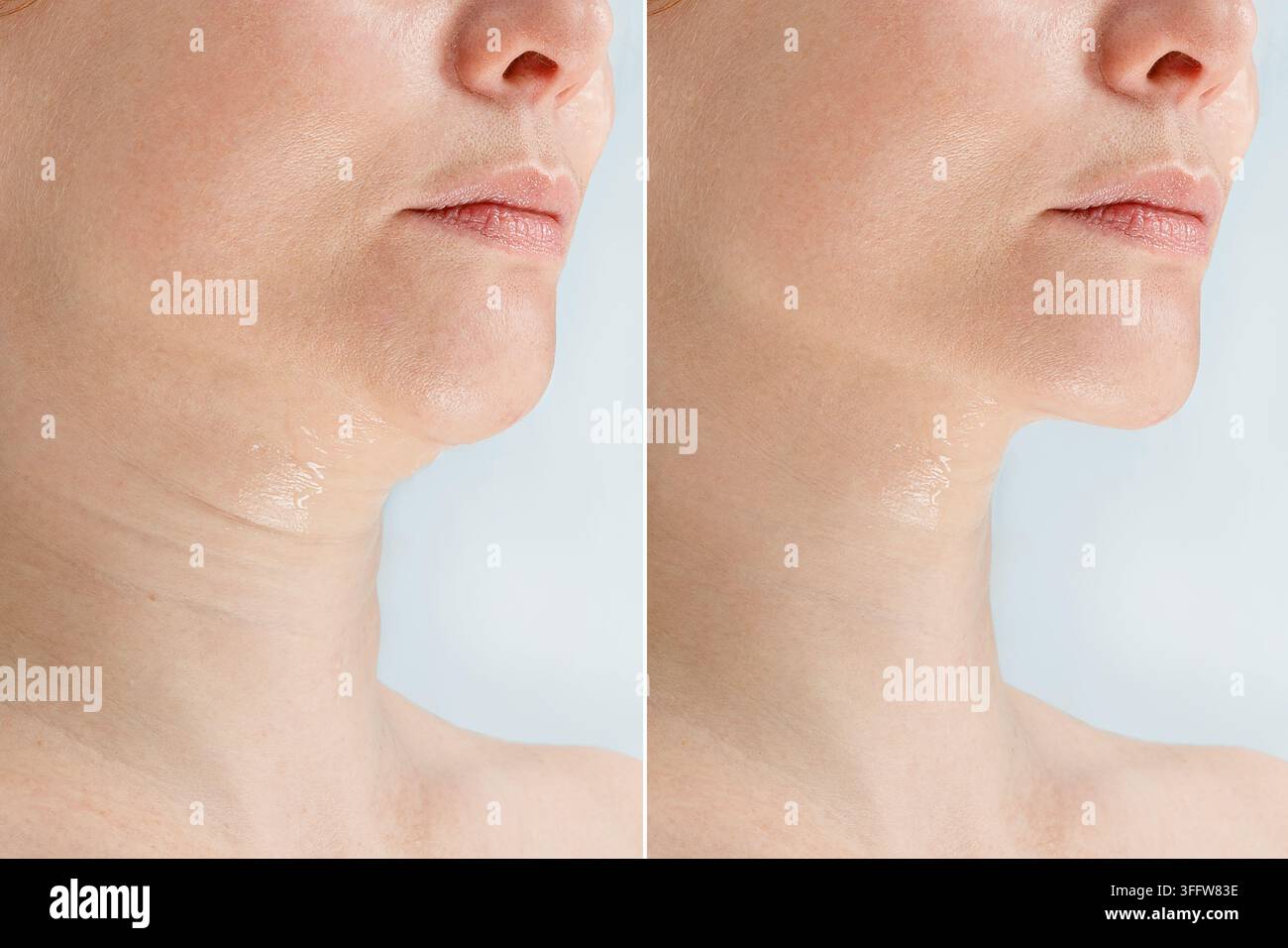 Prima e dopo il trattamento di ringiovanimento del mento che mostra una riduzione del doppio mento e una pelle più ferma Foto Stock