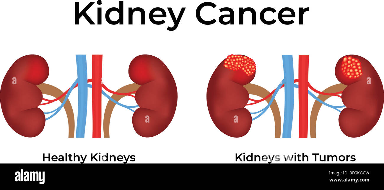 Cancro al rene che mostra un confronto tra reni sani e reni con tumori Illustrazione Vettoriale